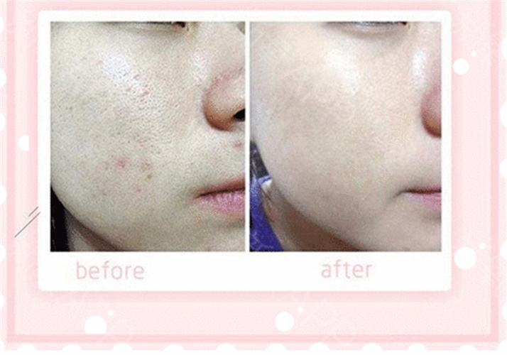 呼和浩特做果酸換膚多少錢