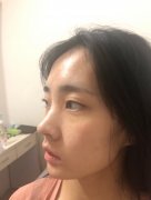 呼和浩特做自體脂肪豐太陽(yáng)穴價(jià)格貴嗎