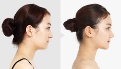 呼市做自體脂肪豐額頭的適應(yīng)人群有哪些?